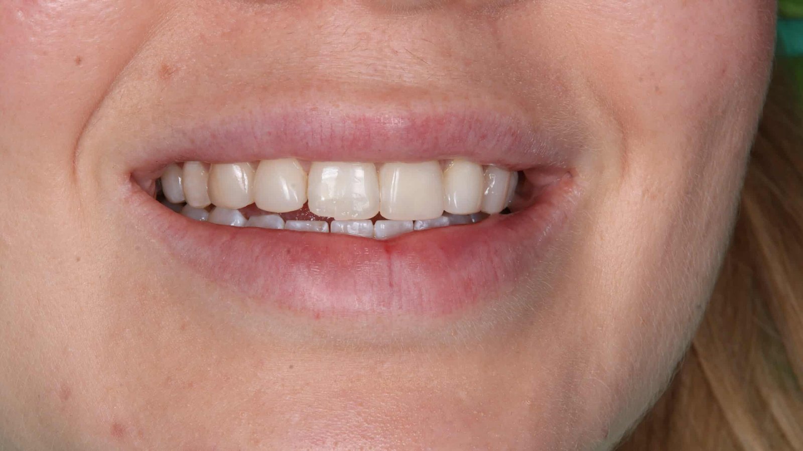 Before Cosmetic Filling