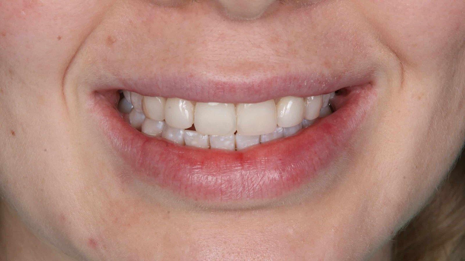 Cosmetic After_Patient Deni R