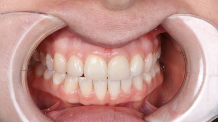 Before and after cosmetic dental treatment by Dr Shreya Rajkumar, Dubai Silicon Oasis & Lucknow