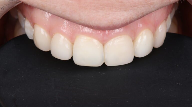 Before and after cosmetic dental treatment by Dr Shreya Rajkumar, Dubai Silicon Oasis & Lucknow