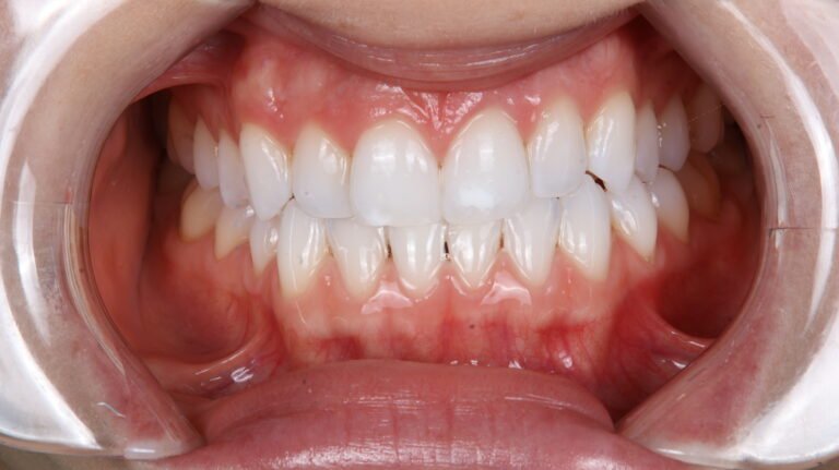 Before and after cosmetic dental treatment by Dr Shreya Rajkumar, Dubai Silicon Oasis & Lucknow