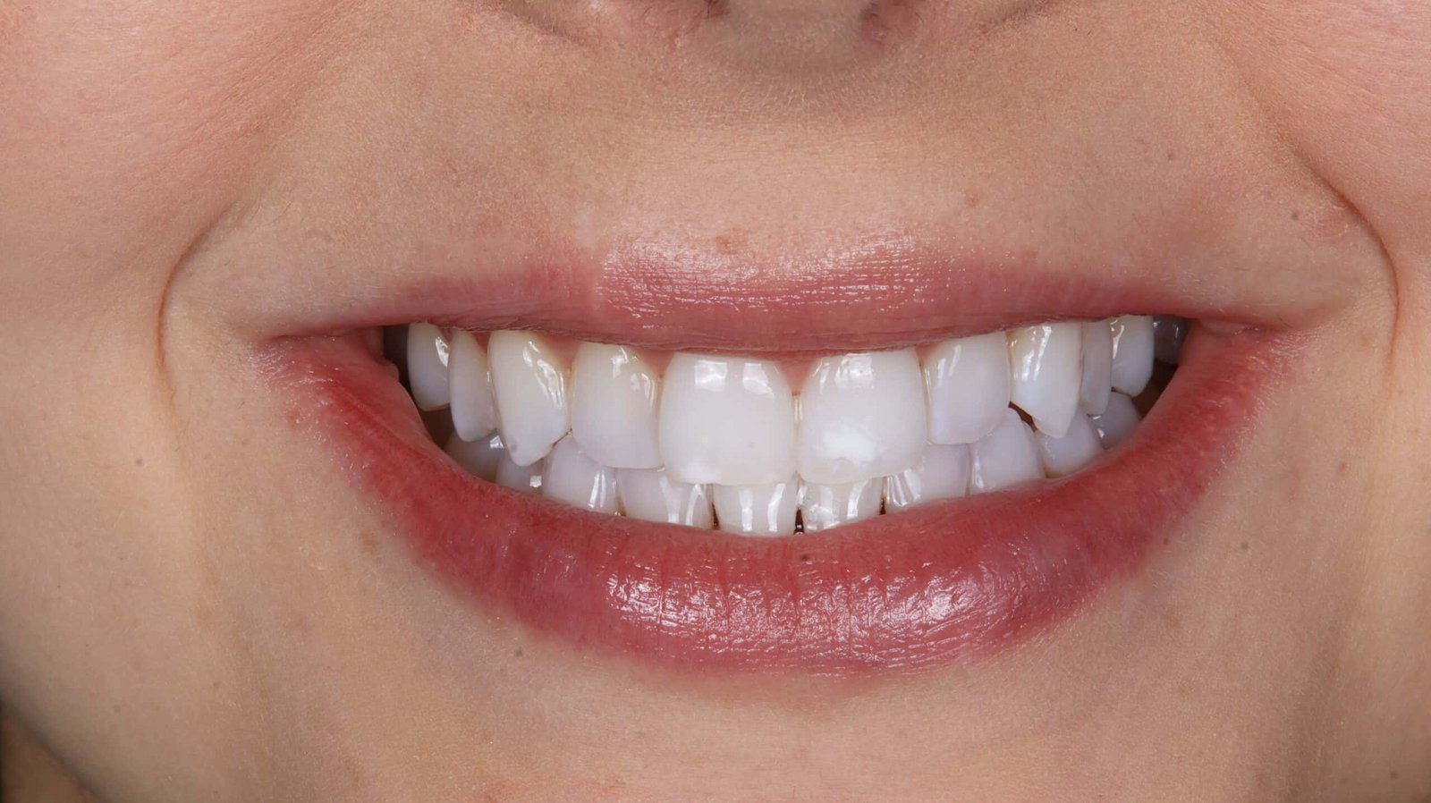 Patient Beatrice After WHitening