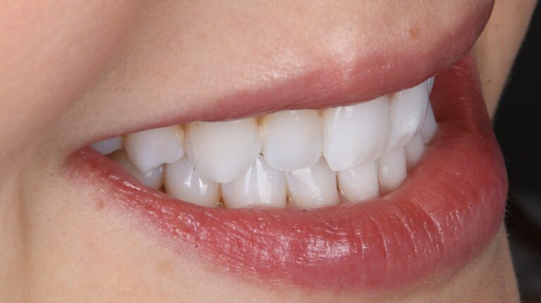 Before and after cosmetic dental treatment by Dr Shreya Rajkumar, Dubai Silicon Oasis & Lucknow