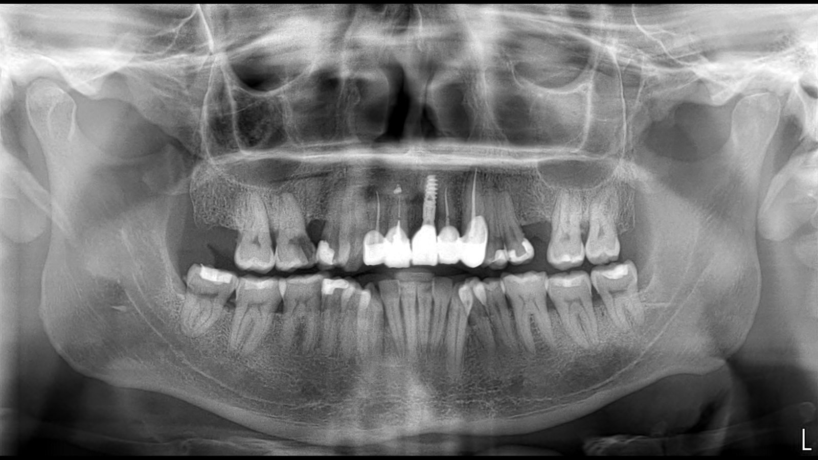 Before and after dental implants treatment by Dr Shreya Rajkumar, Dubai Silicon Oasis & Lucknow