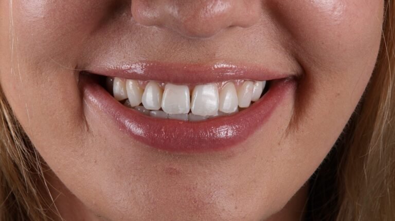 Before and after cosmetic dental treatment by Dr Shreya Rajkumar, Dubai Silicon Oasis & Lucknow
