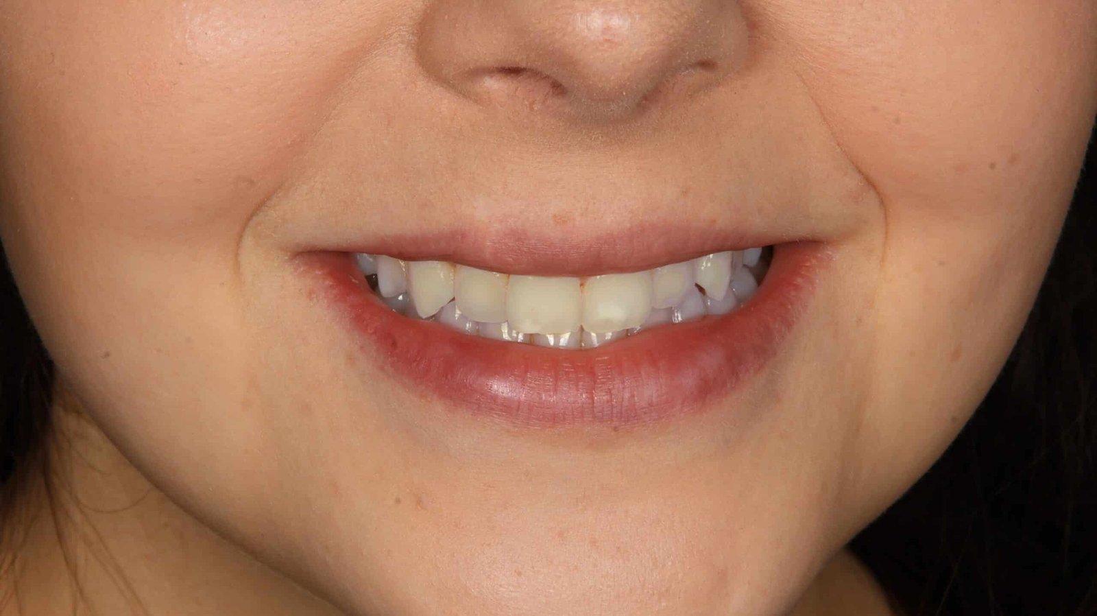 Patient Before - Teeth Whitening
