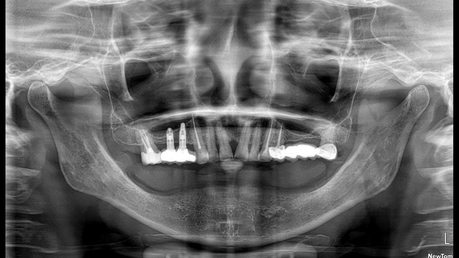 Before and after dental implants treatment by Dr Shreya Rajkumar, Dubai Silicon Oasis & Lucknow