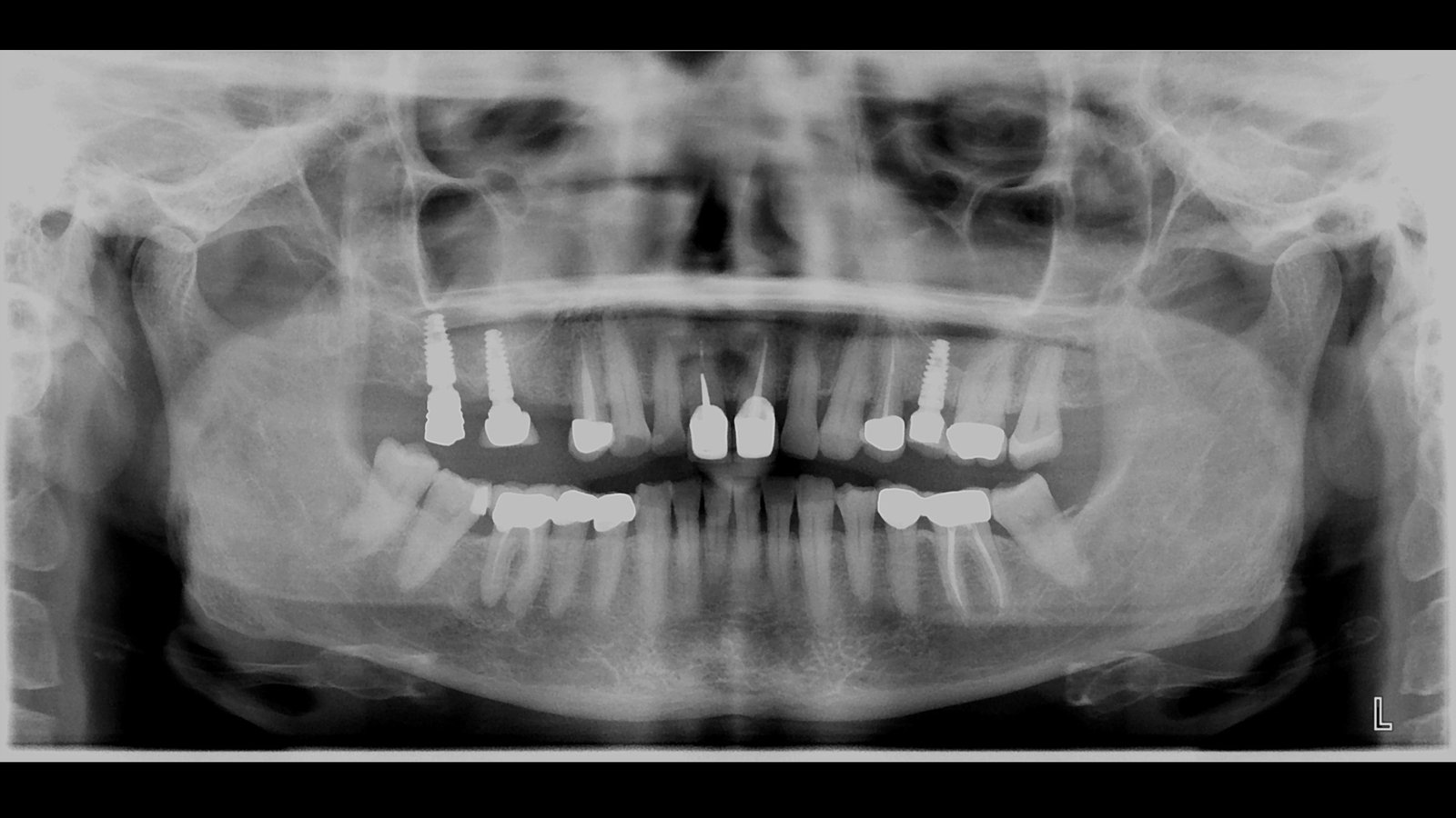 Before and after dental implants treatment by Dr Shreya Rajkumar, Dubai Silicon Oasis & Lucknow
