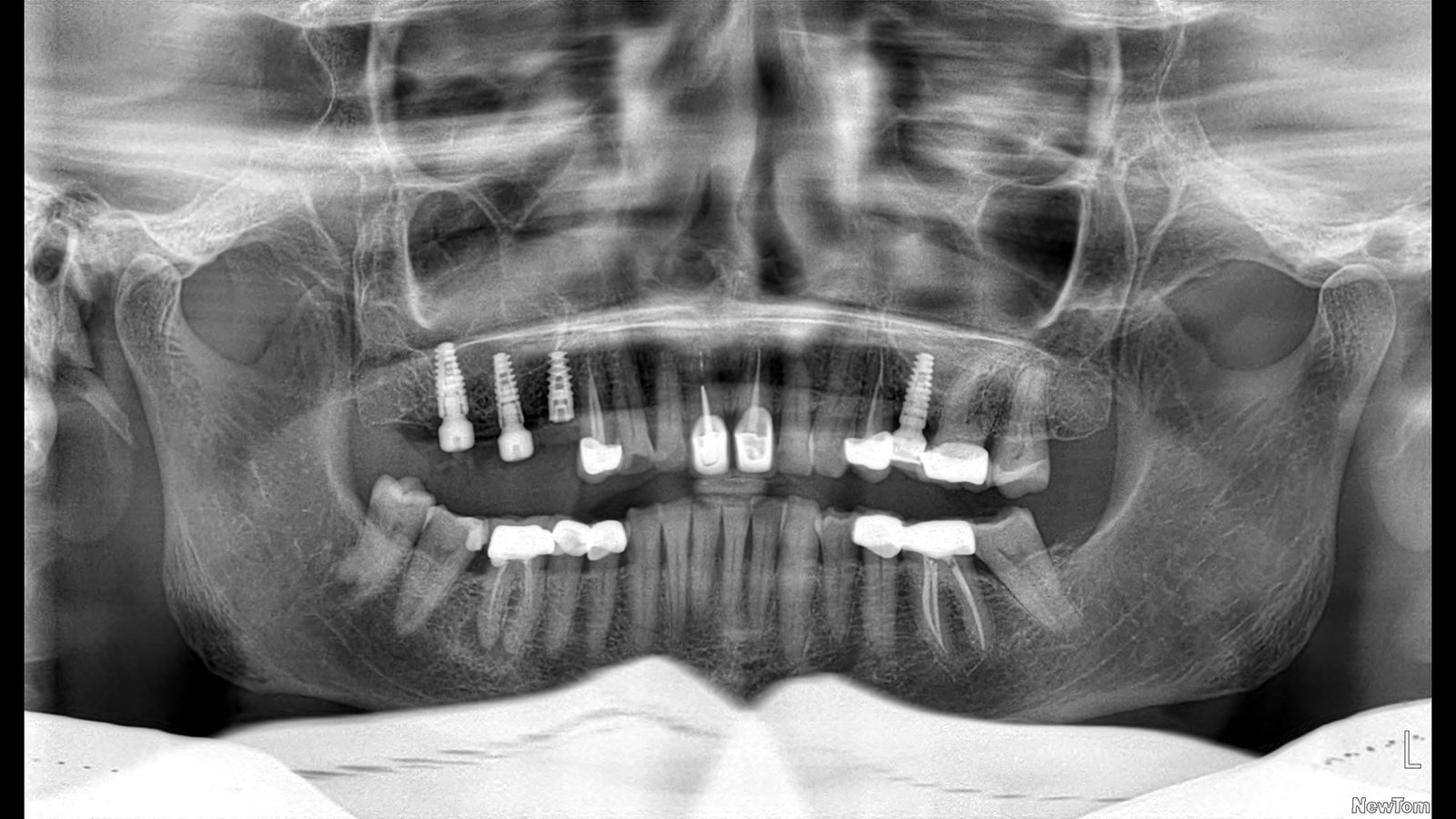 Before and after dental implants treatment by Dr Shreya Rajkumar, Dubai Silicon Oasis & Lucknow