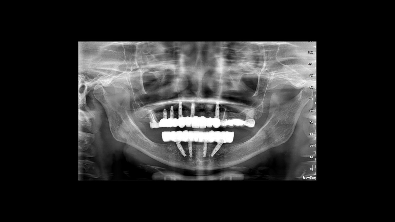 Before and after dental implants treatment by Dr Shreya Rajkumar, Dubai Silicon Oasis & Lucknow