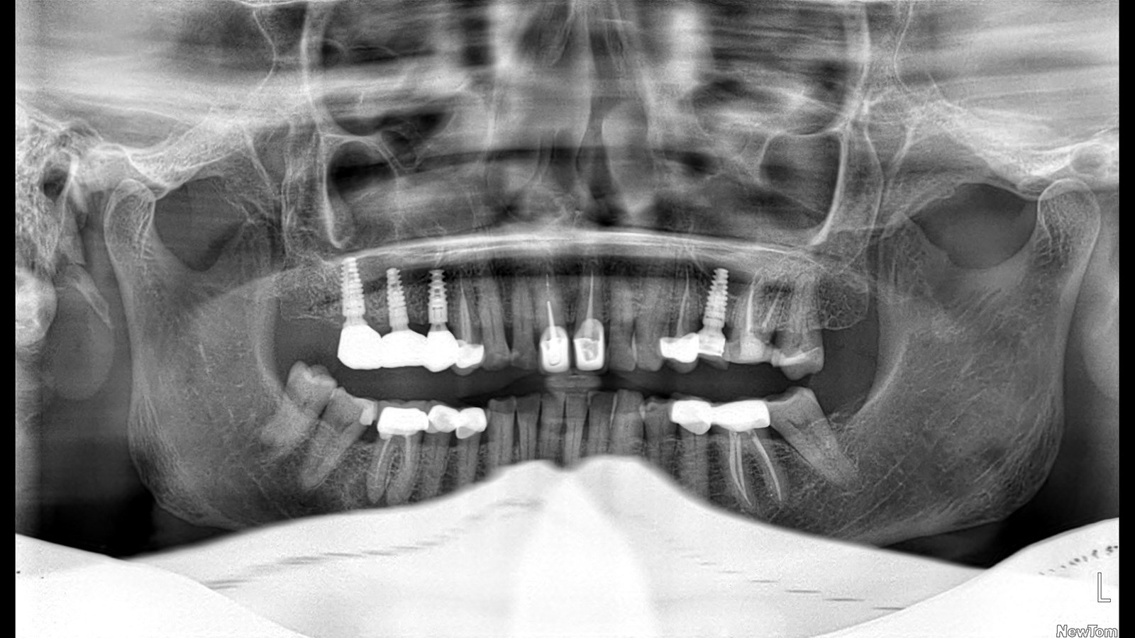 Before and after dental implants treatment by Dr Shreya Rajkumar, Dubai Silicon Oasis & Lucknow